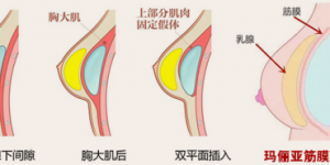 丰胸技术进入“筋膜时代”：更微创、更自然、更安全的新选择