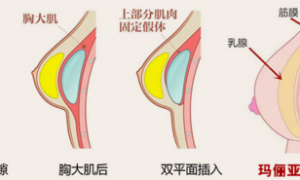 丰胸技术进入“筋膜时代”：更微创、更自然、更安全的新选择